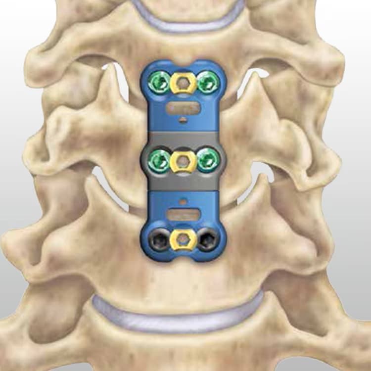 Anterior Cervical Discectomy and Fusion (ACDF)