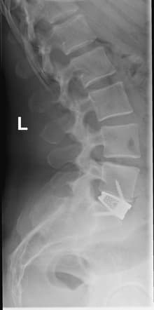 Anterior Lumbar Interbody Fusion (ALIF)