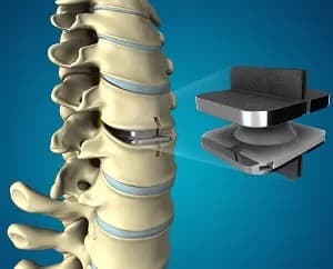 Cervical Disc Replacement (CDR)