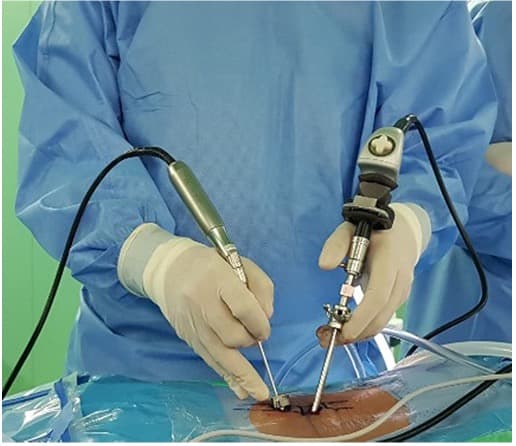 Endoscopic Microdiscectomy/Laminectomy
