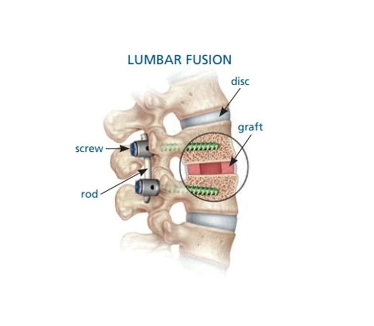 Lumbar Fusion (PLIF/TLIF)