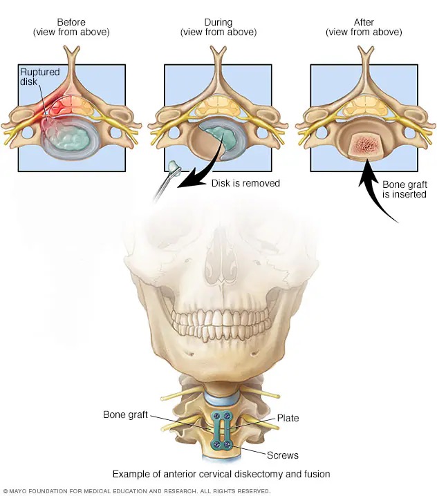 Illustration of the ACDF procedure showing the anterior approach, disc removal, bone graft placement, and plate and screw fixation